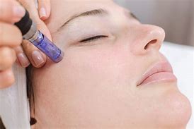 What Is Micro Needling?